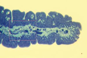 M,60y. | jejunum - amyloidosis(semithin section)